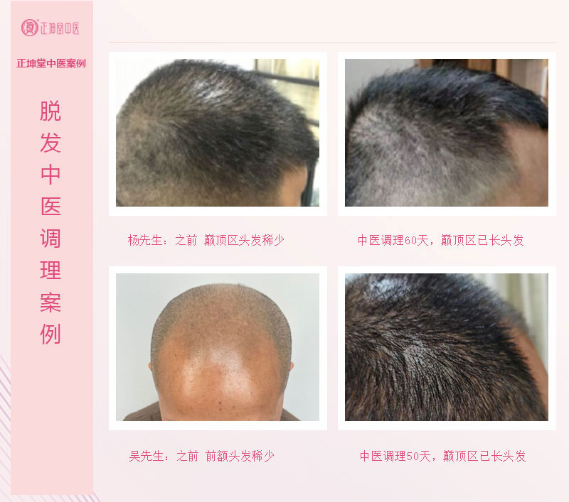 脱发该怎么办