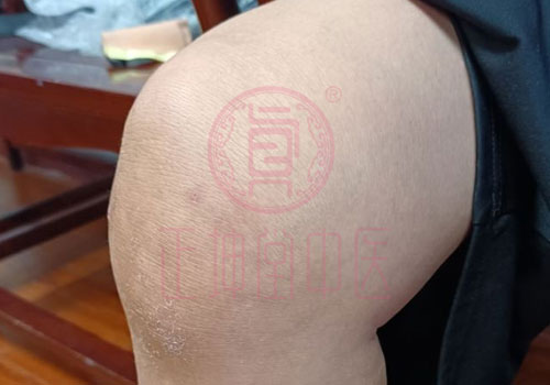 膝关节疼痛该怎么办