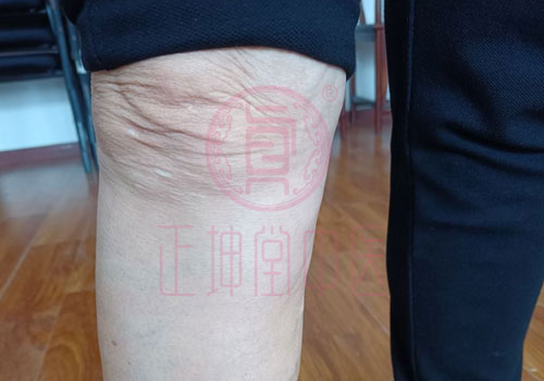 膝关节疼痛该怎么办