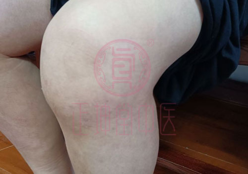 膝关节疼痛该怎么办