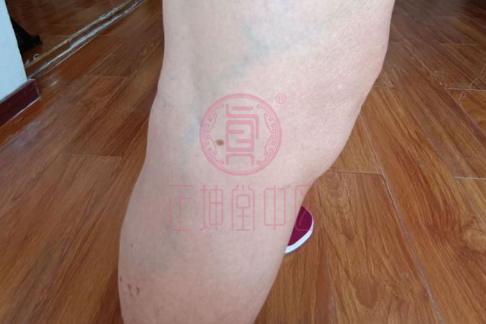 膝关节疼痛如何治愈