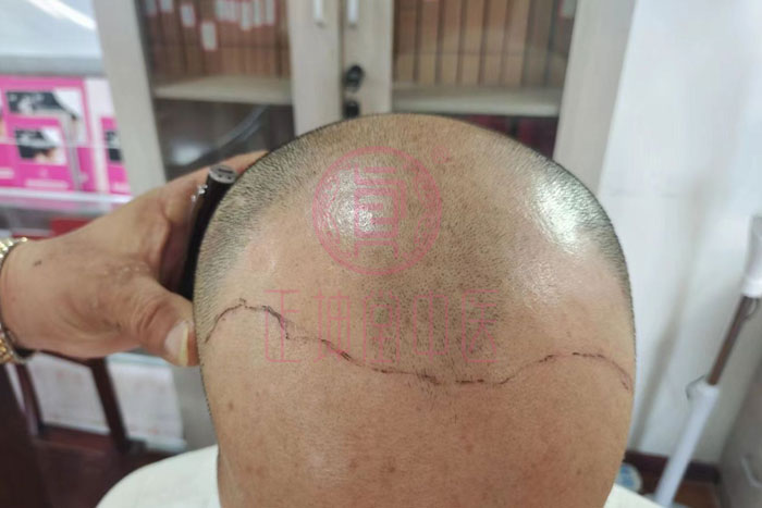 如何解决脱发好