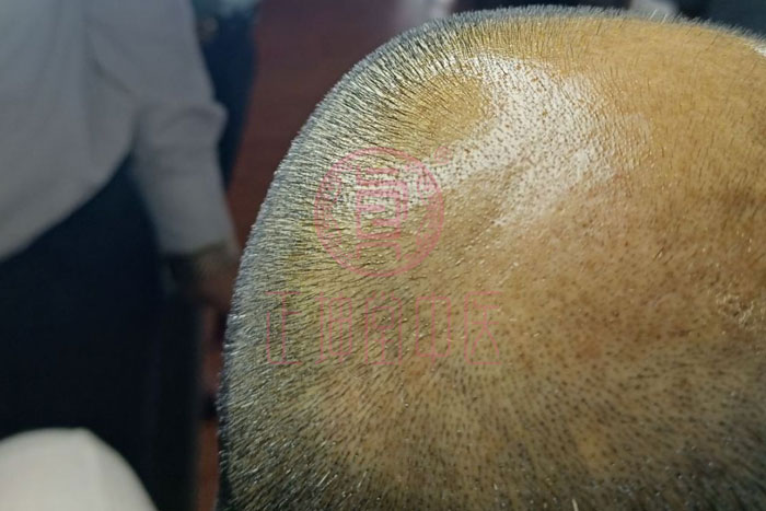 如何解决脱发好