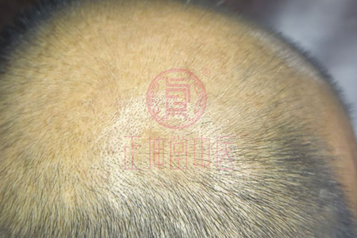 如何解决脱发好