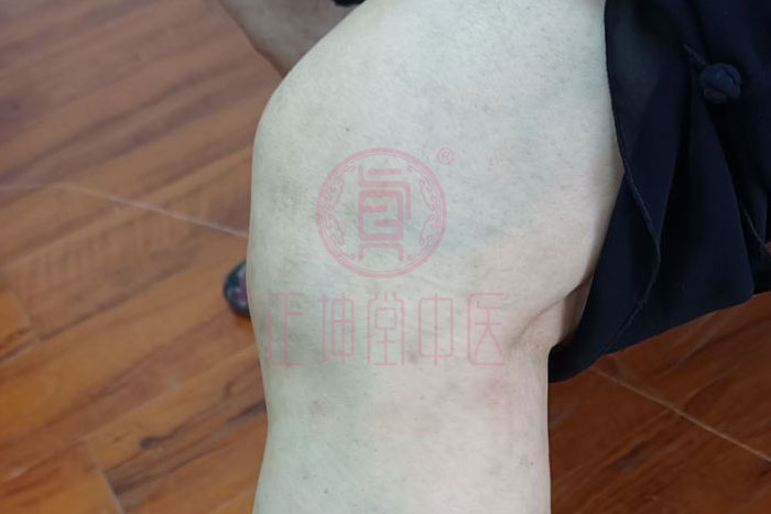 老年人膝关节疼痛怎么办？