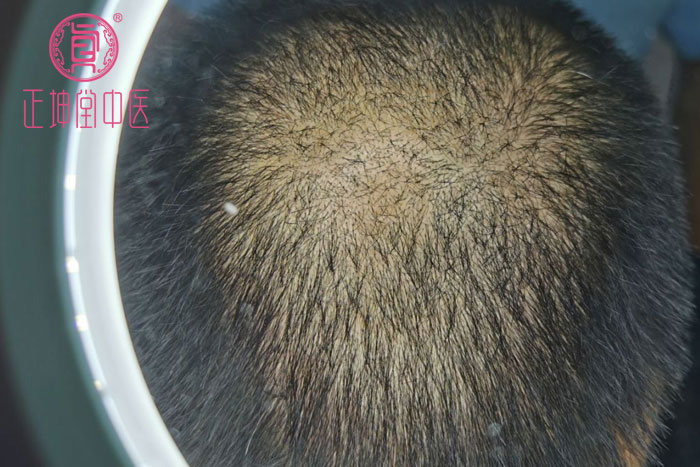 头顶斑秃哪里可以治愈