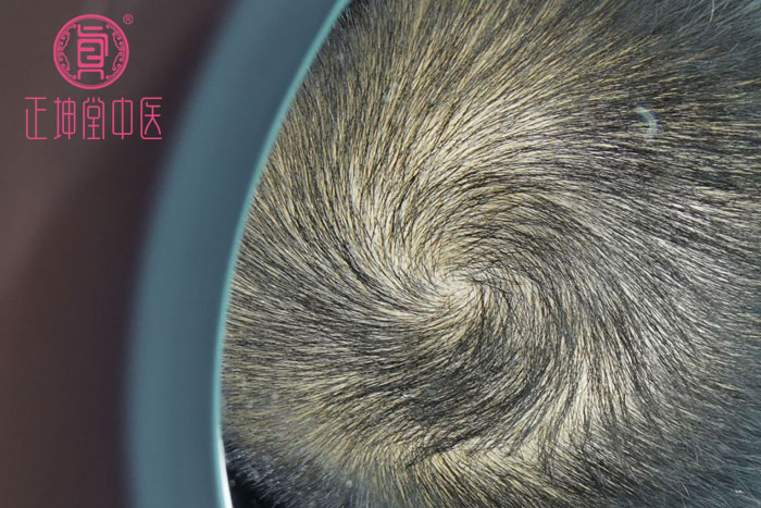 头顶斑秃哪里可以治愈