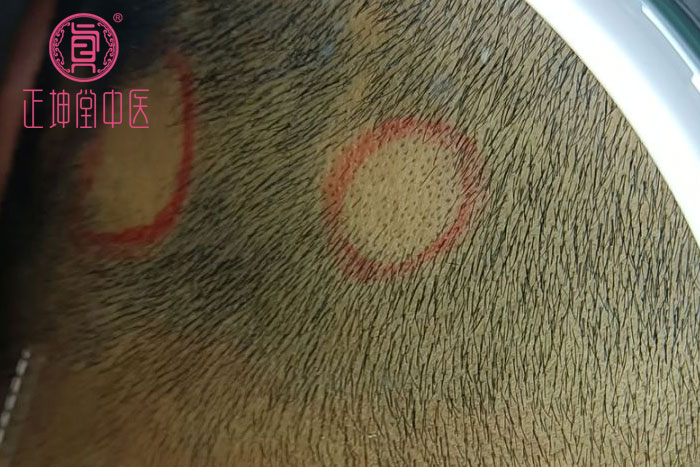 治愈斑秃最快的方法