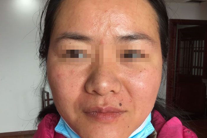赵女士产后衰老皮肤老化干燥