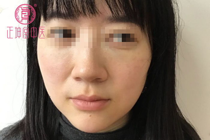 衰老期皮肤松弛