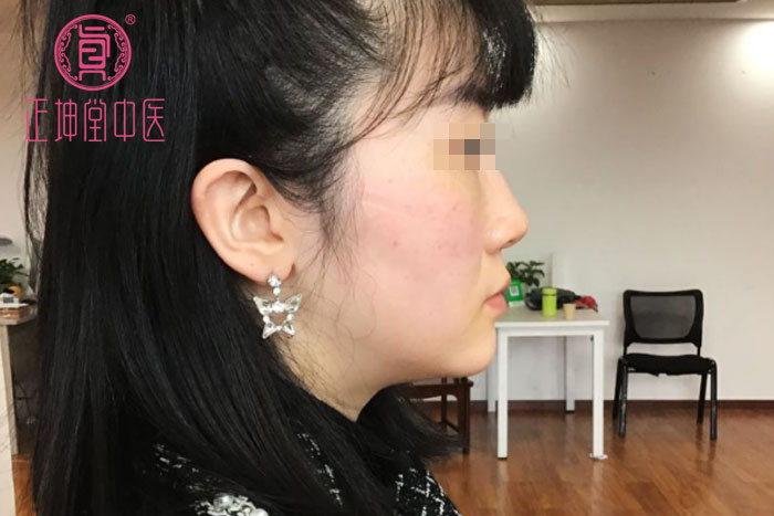 衰老期皮肤松弛