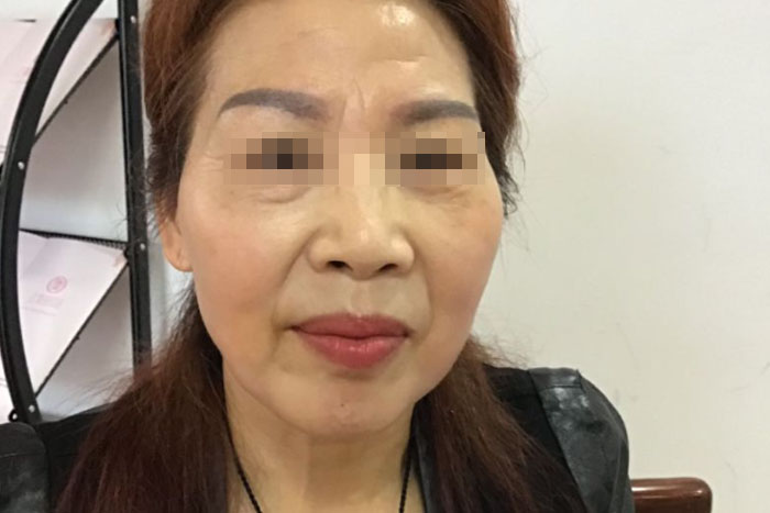 李女士老年期衰老治愈案例