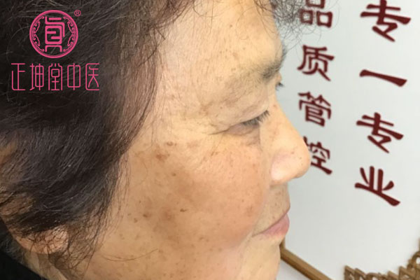 老年期衰老治愈案例