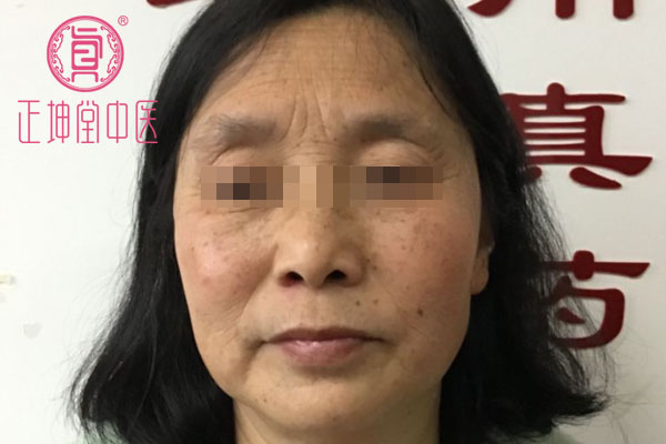 老年期衰老案例
